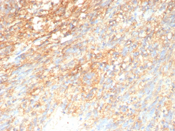 Formalin-fixed, paraffin-embedded human GIST stained with CD117 Recombinant Mouse Monoclonal Antibody (rC117/9253. HIER: Tris/EDTA, pH9.0, 45min. 2°C: HRP-polymer, 30min. DAB, 5min.