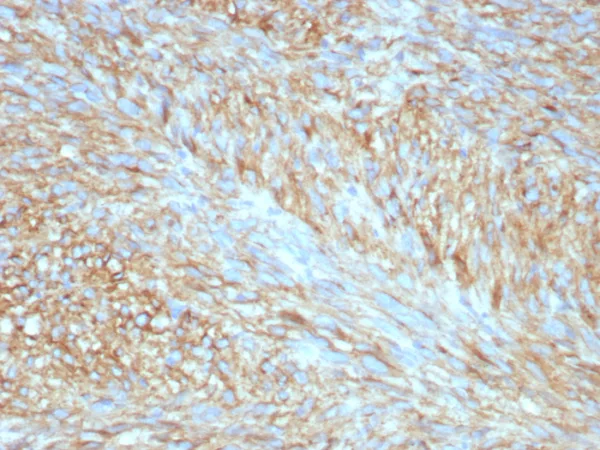Formalin-fixed, paraffin-embedded human GIST stained with CD117 Recombinant Rabbit Monoclonal Antibody (C117/8399R) at 2ug/ml. HIER: Tris/EDTA, pH9.0, 45min. 2°C: HRP-polymer, 30min. DAB, 5min.