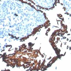 Formalin-fixed, paraffin-embedded human tonsil stained with Cytokeratin 5 Recombinant Rabbit Monoclonal Antibody (KRT5/7500R). HIER: Tris/EDTA, pH9.0, 45min. 2°C: HRP-polymer, 30min. DAB, 5min.