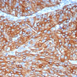 Formalin-fixed, paraffin-embedded human lung adenocarcinoma stained with Cytokeratin 6A Recombinant Rabbit Monoclonal Antibody (KRT6/8120R). HIER: Tris/EDTA, pH9.0, 45min. 2: HRP-polymer, 30min. DAB, 5min.