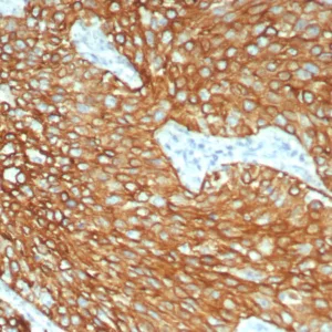 Formalin-fixed, paraffin-embedded human lung stained with Cytokeratin 6A Recombinant Rabbit Monoclonal Antibody (KRT6/8198R). HIER: Tris/EDTA, pH9.0, 45min. 2: HRP-polymer, 30min. DAB, 5min.