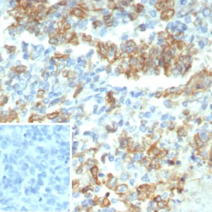 Formalin-fixed, paraffin-embedded human ovarian carcinoma stained with Cytokeratin-7 Mouse Monoclonal Antibody (KRT7/3733). Inset: PBS instead of primary antibody; secondary only negative control.