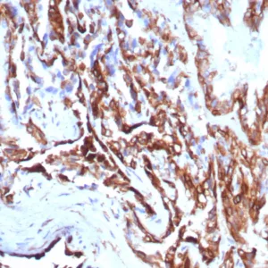 Formalin-fixed, paraffin-embedded human prostate carcinoma stained with CK7 Recombinant Mouse Monoclonal Antibody (rKRT7/8763). HIER: Tris/EDTA, pH9.0, 45min. 2°C: HRP-polymer, 30min. DAB, 5min.