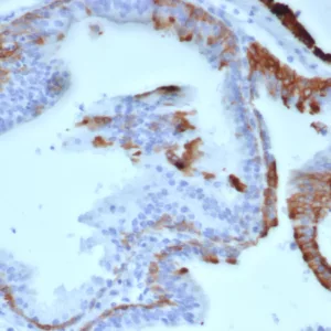 Formalin-fixed, paraffin-embedded human prostate carcinoma stained with Cytokeratin 14 Mouse Monoclonal Antibody (KRT14/6956). HIER: Tris/EDTA, pH9.0, 45min. 2°C: HRP-polymer, 30min. DAB, 5min.