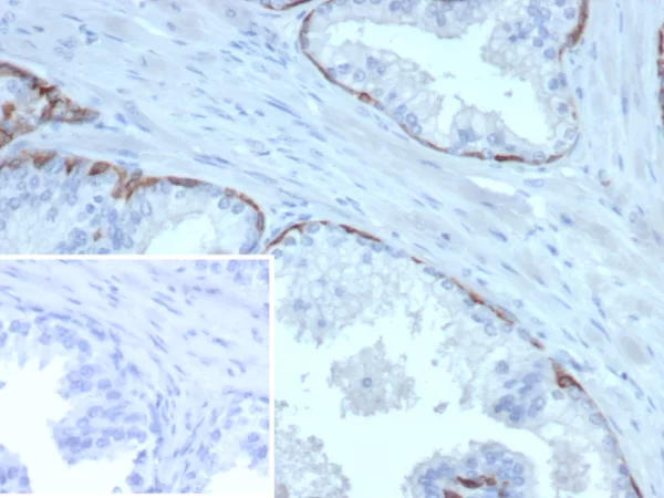 Formalin-fixed, paraffin-embedded human prostate carcinoma stained with Keratin 10 Mouse Monoclonal Antibody (KRT14/6962). Inset: PBS instead of primary antibody; secondary only negative control.