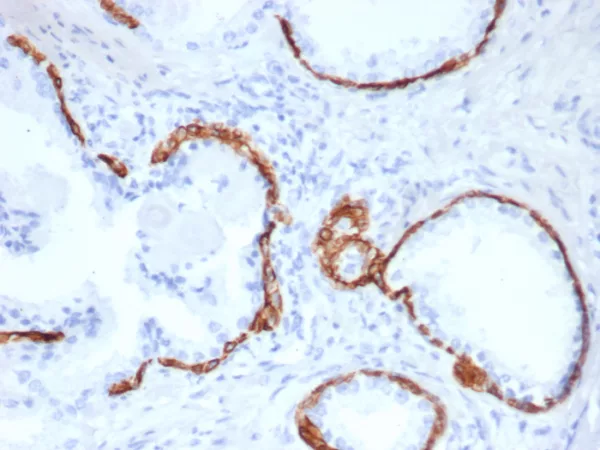 Formalin-fixed, paraffin-embedded human prostate carcinoma stained with Keratin 10 Mouse Monoclonal Antibody (KRT14/6962). HIER: Tris/EDTA, pH9.0, 45min. 2°C: HRP-polymer, 30min. DAB, 5min.