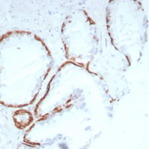 IHC analysis of formalin-fixed, paraffin-embedded human prostate. Negative tissue control using rKRT14/8692). at 2ug/ml in PBS for 30min RT.  HIER: Tris/EDTA, pH9.0, 45min. 2°C: HRP-polymer, 30min. DAB, 5min.