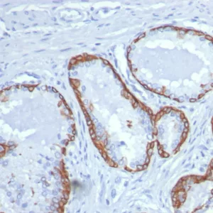 Formalin-fixed, paraffin-embedded human prostate stained with KRT14 Recombinant Rabbit Monoclonal Antibody (KRT14/8260R). HIER: Tris/EDTA, pH9.0, 45min. 2°C: HRP-polymer, 30min. DAB, 5min.