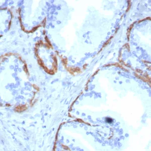 Formalin-fixed, paraffin-embedded human prostate stained with KRT14 Recombinant Rabbit Monoclonal Antibody (KRT14/8261R). HIER: Tris/EDTA, pH9.0, 45min. 2°C: HRP-polymer, 30min. DAB, 5min.