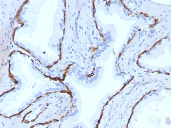 Formalin-fixed, paraffin-embedded human prostate stained with KRT14 Recombinant Rabbit Monoclonal Antibody (KRT14/7977R). HIER: Tris/EDTA, pH9.0, 45min. 2: HRP-polymer, 30min. DAB, 5min.