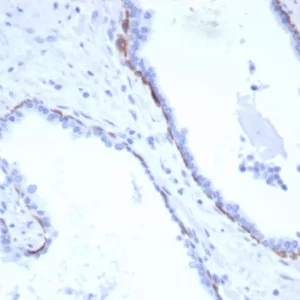 Formalin-fixed, paraffin-embedded human prostate carcinoma stained with CK17 Recombinant Rabbit Monoclonal Antibody (KRT17/8320R). HIER: Tris/EDTA, pH9.0, 45min. 2°C: HRP-polymer, 30min. DAB, 5min.