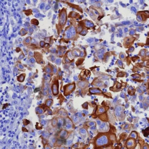 Formalin-fixed, paraffin-embedded human lung adenocarcinoma stained with CK17 Recombinant Rabbit Monoclonal Antibody (KRT17/8346R). HIER: Tris/EDTA, pH9.0, 45min. 2: HRP-polymer, 30min. DAB, 5min.