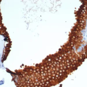 Formalin-fixed, paraffin-embedded human prostate carcinoma stained with  Cytokeratin 18 Recombinant Mouse Monoclonal Antibody (rKRT18/7299). HIER: Tris/EDTA, pH9.0, 45min. 2°C: HRP-polymer, 30min. DAB, 5min.