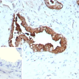 Formalin-fixed, paraffin-embedded human prostate cancer stained with Cytokeratin 19 Recombinant Mouse Monoclonal Antibody (rKRT19/9108). HIER: Tris/EDTA, pH9.0, 45min. 2°C: HRP-polymer, 30min. DAB, 5min.