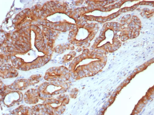 Formalin-fixed, paraffin-embedded human prostate stained with CD107a / LAMP1 Mouse Monoclonal Antibody (LAMP1/7458). HIER: Tris/EDTA, pH9.0, 45min. 2°C: HRP-polymer, 30min. DAB, 5min.