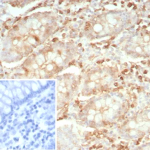 Formalin-fixed, paraffin-embedded human colon carcinoma stained with Stathmin 1 Recombinant Mouse Monoclonal Antibody (rSTMN1/9255). Inset: PBS instead of primary antibody; secondary only negative control.