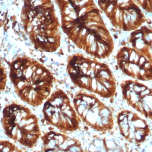 Formalin-fixed, paraffin-embedded human colon stained with Stathmin 1 Mouse Monoclonal Antibody (STMN1/8012). HIER: Tris/EDTA, pH9.0, 45min. 2°C: HRP-polymer, 30min. DAB, 5min.