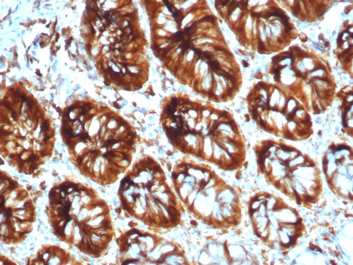 Formalin-fixed, paraffin-embedded human colon stained with Stathmin 1 Mouse Monoclonal Antibody (STMN1/8012). HIER: Tris/EDTA, pH9.0, 45min. 2°C: HRP-polymer, 30min. DAB, 5min. Stathmin 1 / STMN1 Antibody