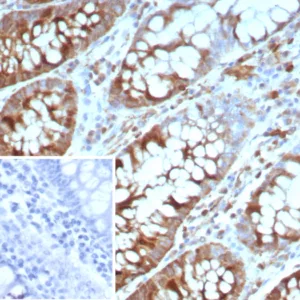Formalin-fixed, paraffin-embedded human colon carcinoma stained with Stathmin 1 Mouse Monoclonal Antibody (STMN1/8437). Inset: PBS instead of primary antibody; secondary only negative control.