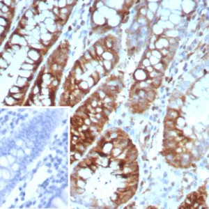 Formalin-fixed, paraffin-embedded human colon carcinoma stained with Stathmin 1 Mouse Monoclonal Antibody (STMN1/8439). Inset: PBS instead of primary antibody; secondary only negative control.