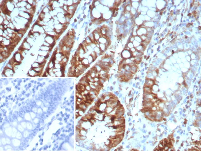 Formalin-fixed, paraffin-embedded human colon carcinoma stained with Stathmin 1 Mouse Monoclonal Antibody (STMN1/8439). Inset: PBS instead of primary antibody; secondary only negative control. Stathmin 1 / STMN1 Antibody