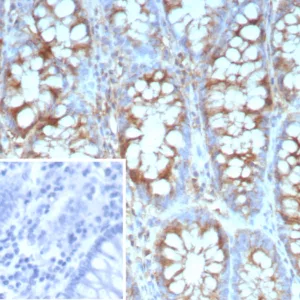 Formalin-fixed, paraffin-embedded human colon carcinoma stained with Stathmin 1 Recombinant Rabbit Monoclonal Antibody (STMN1/9227R). Inset: PBS instead of primary antibody; secondary only negative control.