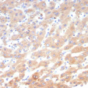 Formalin-fixed, paraffin-embedded human hepatocellular carcinoma stained with Leptin Receptor Mouse Monoclonal Antibody (LEPR/4545). HIER: Tris/EDTA, pH9.0, 45min. 2: HRP-polymer, 30min. DAB, 5min.
