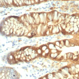 Formalin-fixed, paraffin-embedded human colon stained with Galectin-3 Recombinant Mouse Monoclonal Antibody (rLGALS3/7286). HIER: Tris/EDTA, pH9.0, 45min. 2°C: HRP-polymer, 30min. DAB, 5min.