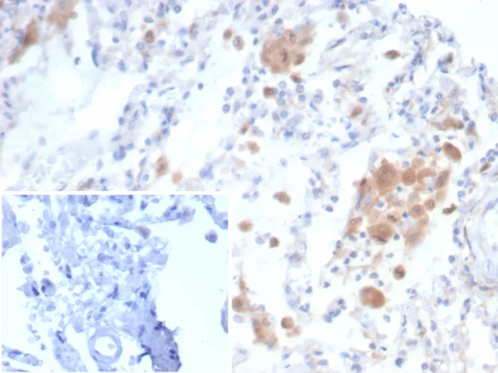 Formalin-fixed, paraffin-embedded human lung stained with CD91 / LRP1 Mouse Monoclonal Antibody (LRP1/6784) Inset: PBS instead of primary antibody; secondary only negative control. CD91 / LDL Receptor Related Protein 1 (LRP1) Antibody