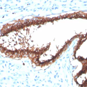 Formalin-fixed, paraffin-embedded human breast carcinoma stained with Lactotransferrin Mouse Monoclonal Antibody (LTF/4072). HIER: Tris/EDTA, pH9.0, 45min. 2°C: HRP-polymer, 30min. DAB, 5min.
