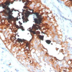 Formalin-fixed, paraffin-embedded human breast carcinoma stained with Lactotransferrin Mouse Monoclonal Antibody (LTF/4077). HIER: Tris/EDTA, pH9.0, 45min. 2°C: HRP-polymer, 30min. DAB, 5min.
