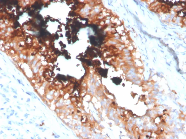Formalin-fixed, paraffin-embedded human breast carcinoma stained with Lactotransferrin Mouse Monoclonal Antibody (LTF/4077). HIER: Tris/EDTA, pH9.0, 45min. 2°C: HRP-polymer, 30min. DAB, 5min.