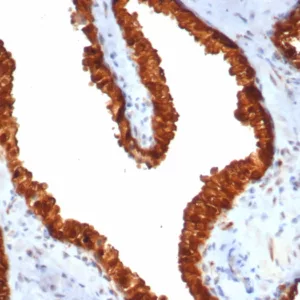 Formalin-fixed, paraffin-embedded human prostate carcinoma stained with TACSTD2 Recombinant Rabbit Monoclonal Antibody (TACSTD2/7348R). HIER: Tris/EDTA, pH9.0, 45min. 2°C: HRP-polymer, 30min. DAB, 5min.