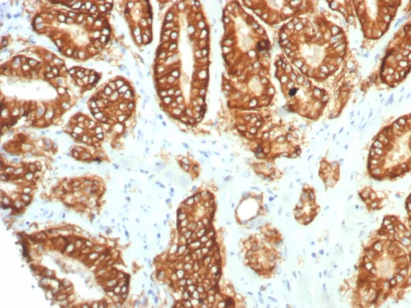 Formalin-fixed, paraffin-embedded human prostate carcinoma stained with TACSTD2 Recombinant Rabbit Monoclonal Antibody (TACSTD2/7349R). HIER: Tris/EDTA, pH9.0, 45min. 2°C: HRP-polymer, 30min. DAB, 5min.
