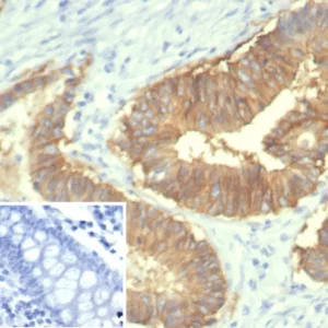 Formalin-fixed, paraffin-embedded human colon stained with EpCAM / CD326 Recombinant Mouse Monoclonal Antibody (rEGP40/7334). Inset: PBS instead of primary antibody; secondary only negative control.