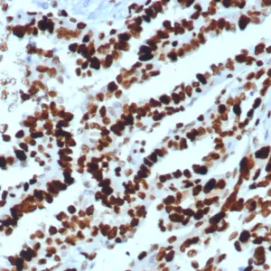 Formalin-fixed, paraffin-embedded human ovarian carcinoma stained with MCM2 Recombinant Rabbit Monoclonal Antibody (MCM2/8006R). Inset: PBS instead of primary antibody, secondary only control.