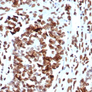 Formalin-fixed, paraffin-embedded human ovarian cancer stained with MDM2 Mouse Monoclonal Antibody (MDM2/7942). HIER: Tris/EDTA, pH9.0, 45min. 2°C: HRP-polymer, 30min. DAB, 5min.
