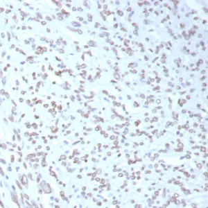 Formalin-fixed, paraffin-embedded human liposarcoma stained with MDM2 Mouse Monoclonal Antibody (MDM2/7943). HIER: Tris/EDTA, pH9.0, 45min. 2°C: HRP-polymer, 30min. DAB, 5min.