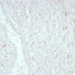 Formalin-fixed, paraffin-embedded human liposarcoma stained with MDM2 Mouse Monoclonal Antibody (MDM2/8221). HIER: Tris/EDTA, pH9.0, 45min. 2°C: HRP-polymer, 30min. DAB, 5min.