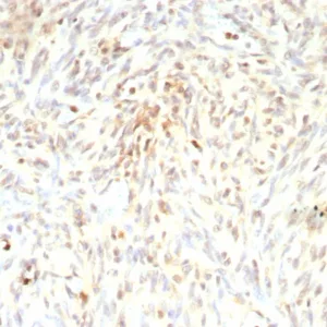 Formalin-fixed, paraffin-embedded human liposarcoma stained with MDM2 Recombinant Mouse Monoclonal Antibody (rMDM2/9214). HIER: Tris/EDTA, pH9.0, 45min. 2°C: HRP-polymer, 30min. DAB, 5min.