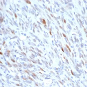 Formalin-fixed, paraffin-embedded human liposarcoma stained with MDM2 Recombinant Rabbit Monoclonal Antibody (MDM2/7190R). HIER: Tris/EDTA, pH9.0, 45min. 2°C: HRP-polymer, 30min. DAB, 5min.