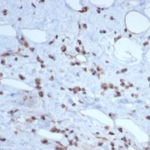 Formalin-fixed, paraffin-embedded human liposarcoma stained with MDM2 Recombinant Rabbit Monoclonal Antibody (MDM2/7189R). HIER: Tris/EDTA, pH9.0, 45min. 2°C: HRP-polymer, 30min. DAB, 5min.