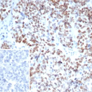 Formalin-fixed, paraffin-embedded human ovarian carcinoma stained with MEIS2 Mouse Monoclonal Antibody (PCRP-MEIS2-2B3). Inset: PBS instead of primary antibody; secondary only negative control.