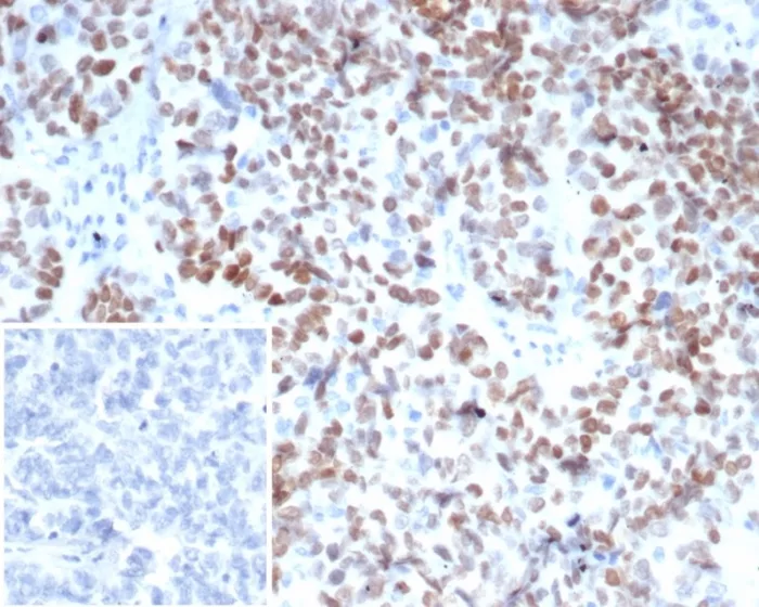 Formalin-fixed, paraffin-embedded human ovarian carcinoma stained with MEIS2 Mouse Monoclonal Antibody (PCRP-MEIS2-2B3). Inset: PBS instead of primary antibody; secondary only negative control. MEIS2 (Transcription Factor) Antibody