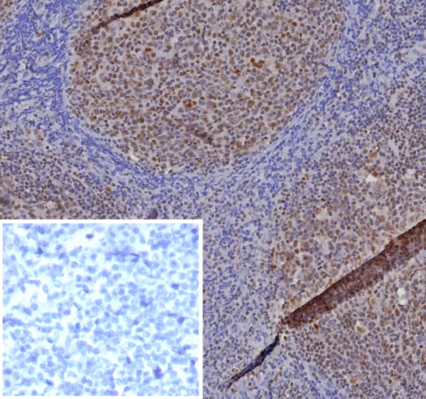 Formalin-fixed, paraffin-embedded human tonsil stained with MGMT Mouse Monoclonal Antibody (MGMT/8364R). HIER: Tris/EDTA, pH9.0, 45min. 2: HRP-polymer, 30min. DAB, 5min.