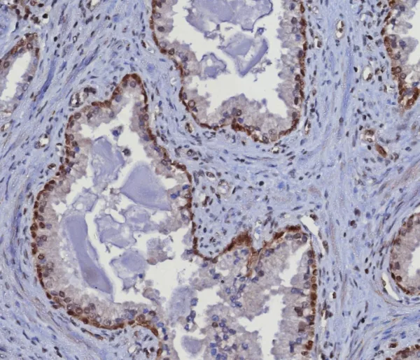 Formalin-fixed, paraffin-embedded human prostate stained with MGMT Mouse Monoclonal Antibody (MGMT/8364R). HIER: Tris/EDTA, pH9.0, 45min. 2: HRP-polymer, 30min. DAB, 5min.