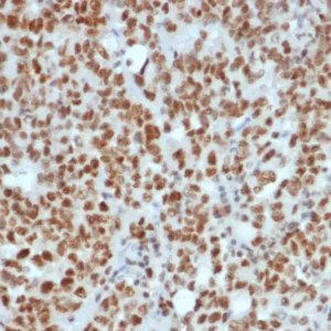 Formalin-fixed, paraffin-embedded human Lynch disease colon stained with MLH1 Mouse Monoclonal Antibody (MLH1/7560). HIER: Tris/EDTA, pH9.0, 45min. 2°C: HRP-polymer, 30min. DAB, 5min.