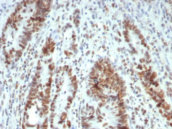 Formalin-fixed, paraffin-embedded human colon stained with MLH1 Mouse Monoclonal Antibody (MLH1/7563). HIER: Tris/EDTA, pH9.0, 45min. 2: HRP-polymer, 30min. DAB, 5min.
