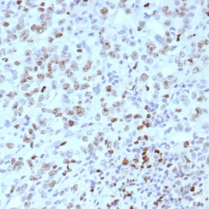 Formalin-fixed, paraffin-embedded human Lynch disease colon stained with MLH1 Recombinant Mouse Monoclonal Antibody (rMLH1/8630). HIER: Tris/EDTA, pH9.0, 45min. 2°C: HRP-polymer, 30min. DAB, 5min.