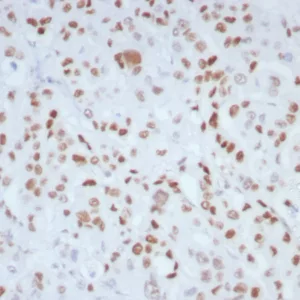 Formalin-fixed, paraffin-embedded human colon stained with MLH1 Recombinant Rabbit Monoclonal (MLH1/8855R).  HIER: Tris/EDTA, pH9.0, 45min. 2°C: HRP-polymer, 30min. DAB, 5min.